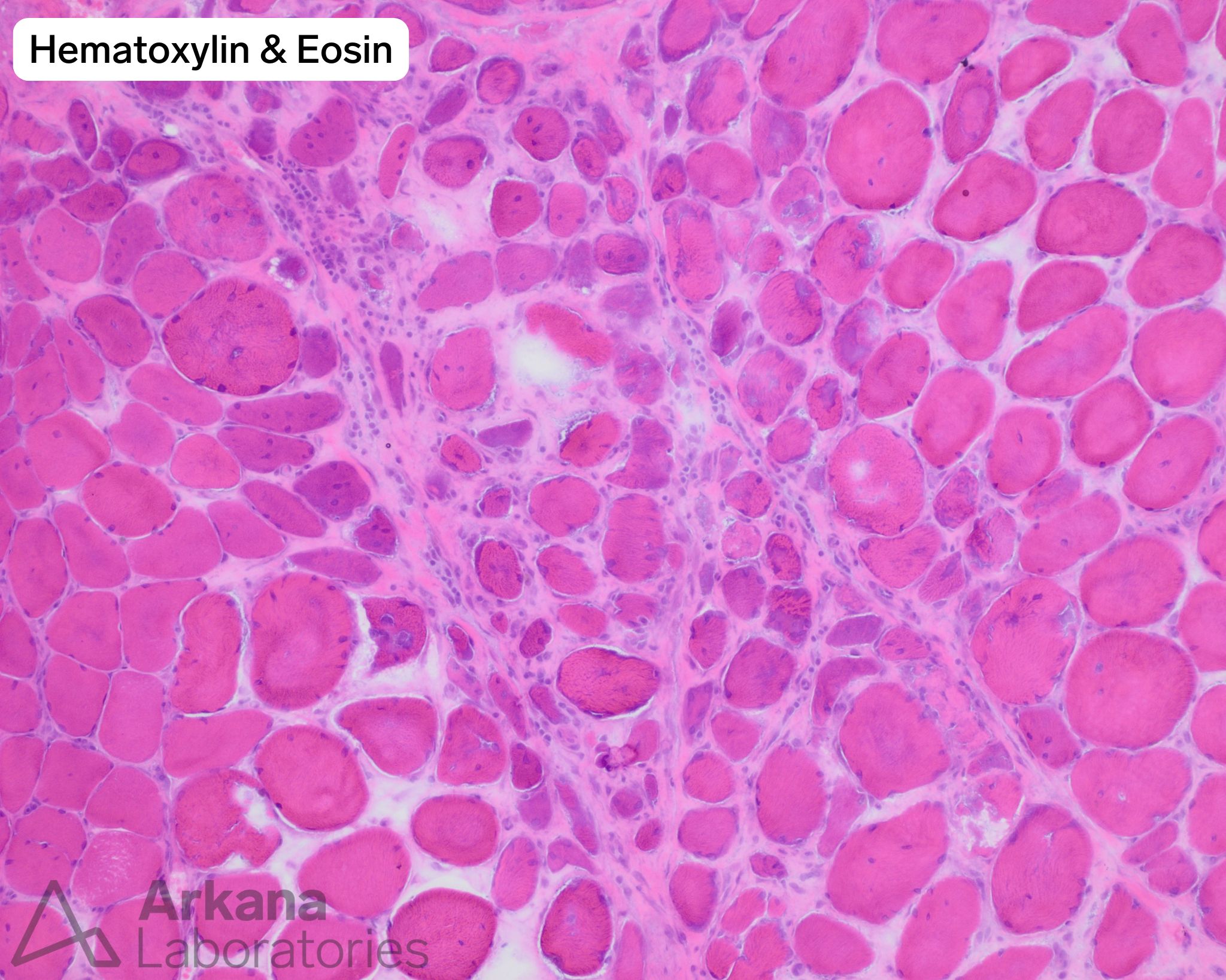 H&E stained image of Anti-TIF1-γ in Dermatomyositis