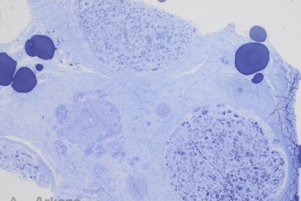 Toluidine blue stained image of vasculitic neuropathy