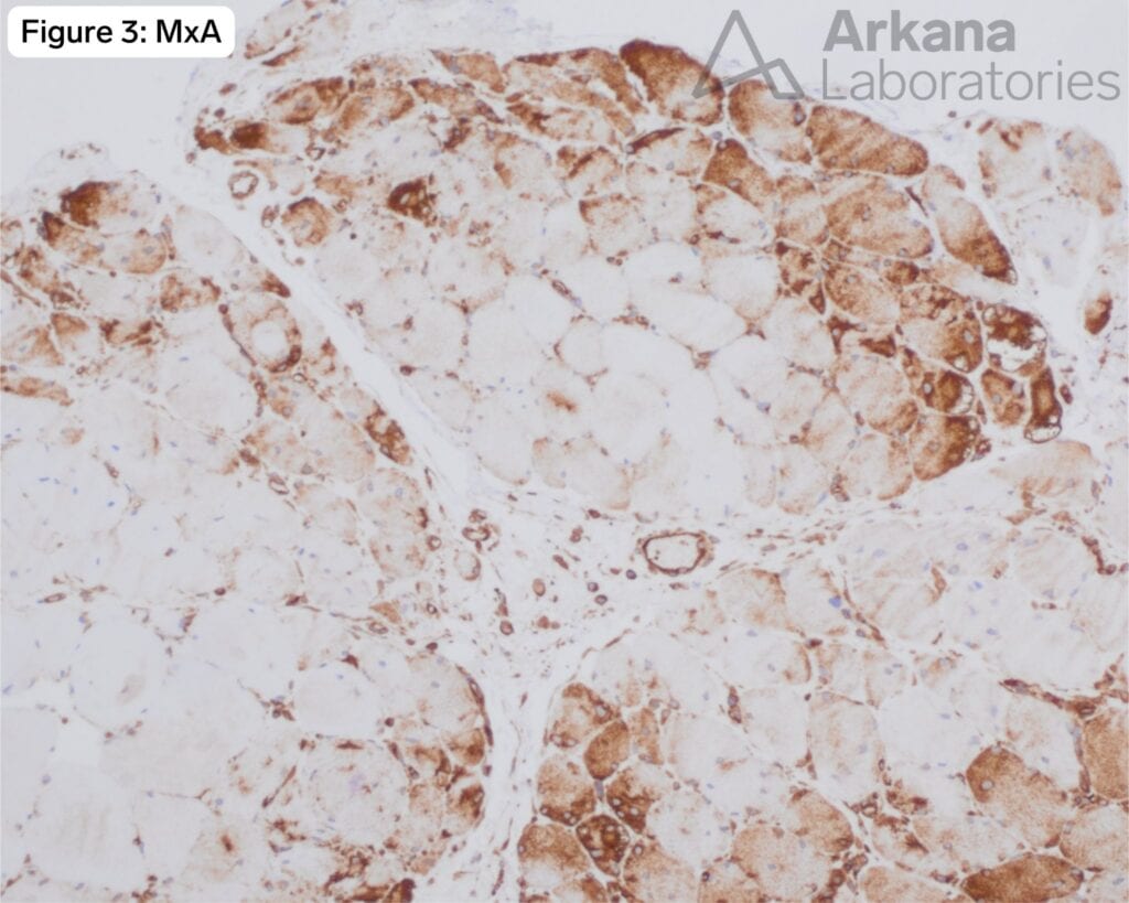 Mxa Rugulation Pathway MxA Positive Myopathy | Neuro Notes | Arkana Laboratories