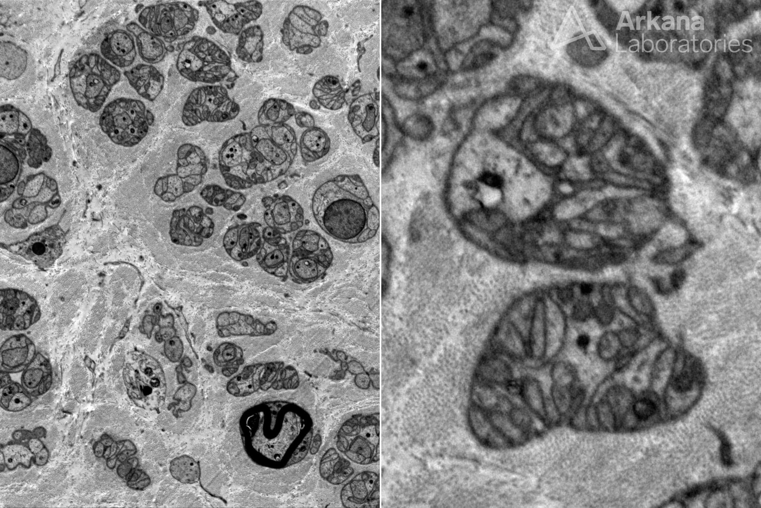 electron microscopy image of axonopathy