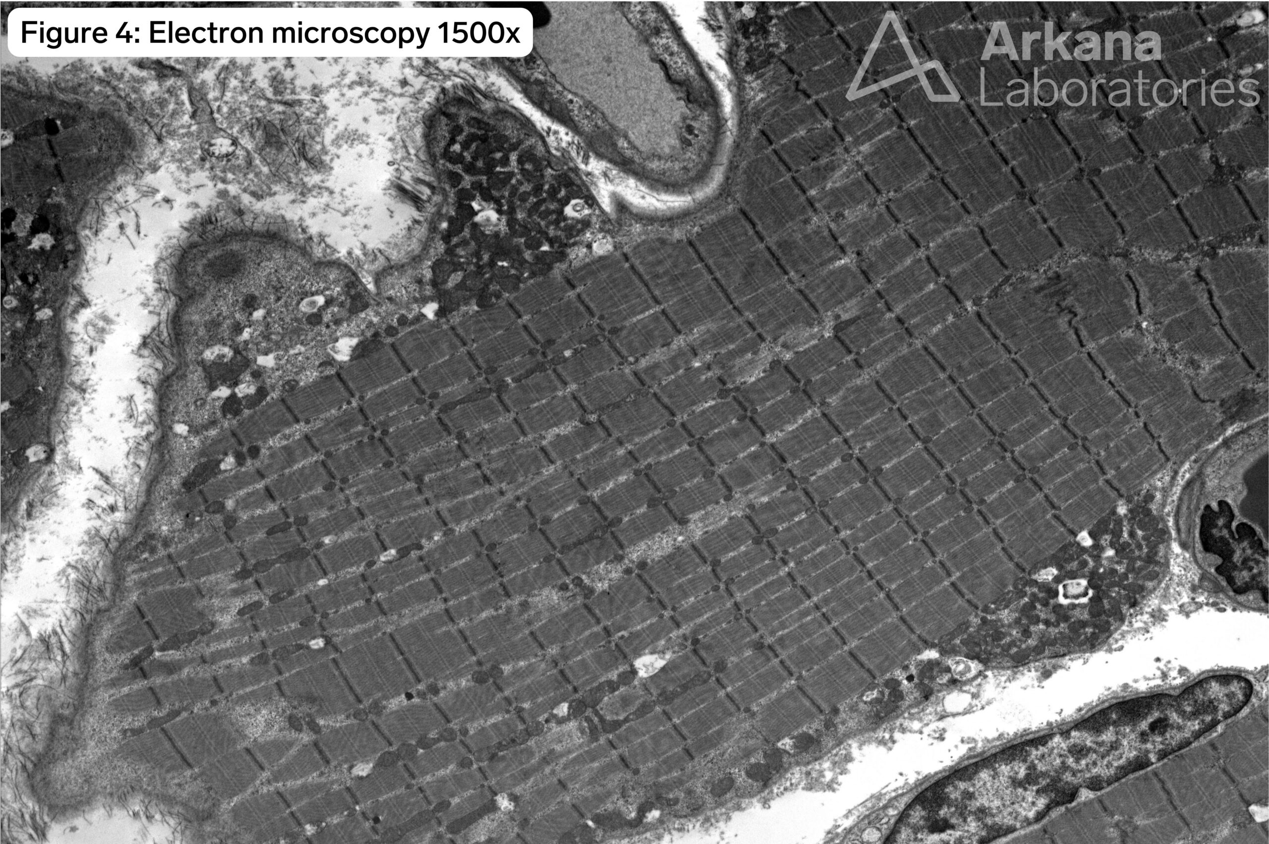 electron microscopy 1500x magnification image of pompe disease