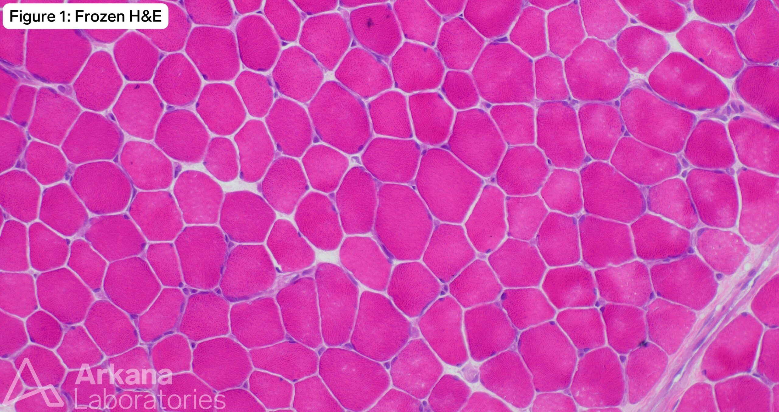 frozen H and E image of pompe disease