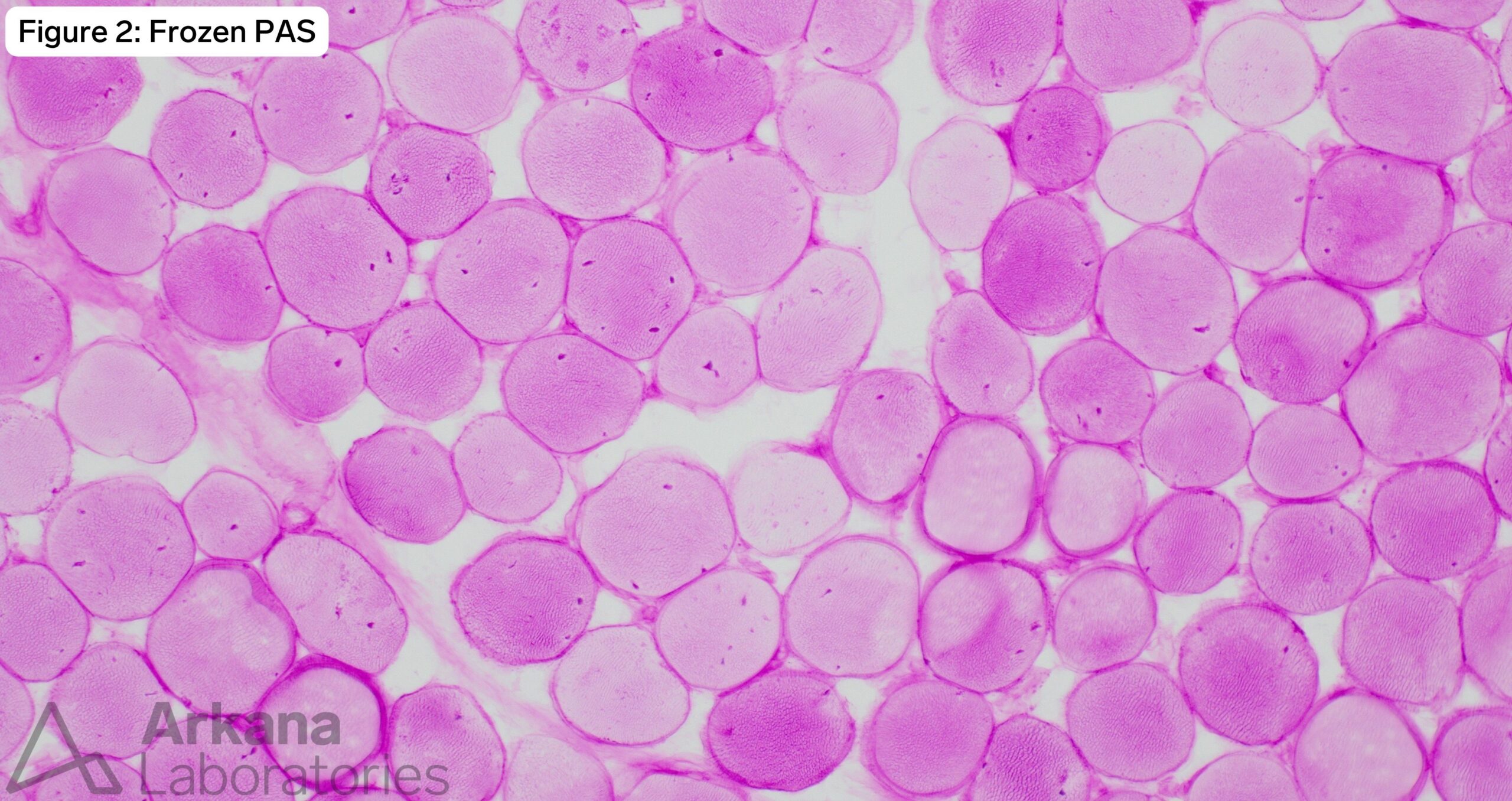 frozen PAS image of pompe disease