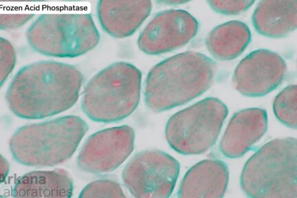 frozen acid phosphatase image of pompe disease