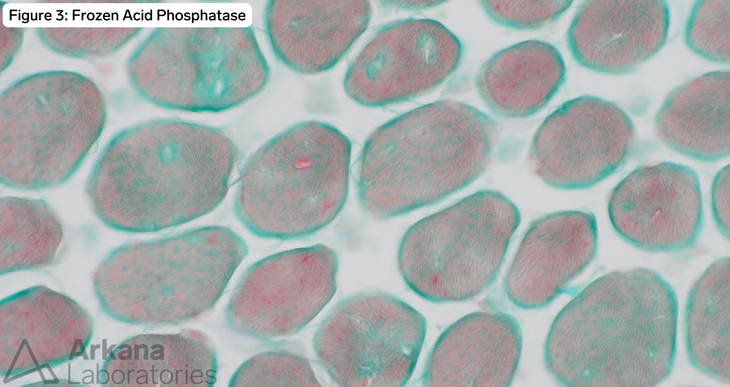 frozen acid phosphatase image of pompe disease