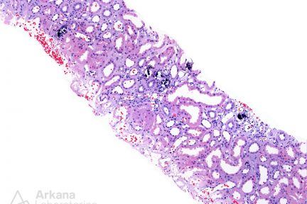 Nephrocalcinosis in Sarcoid, renal cortex