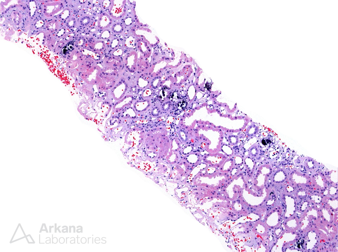 Nephrocalcinosis in Sarcoid, renal cortex