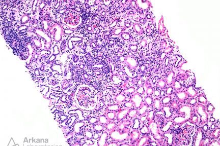 Tubulointerstitial nephritis with uveitis