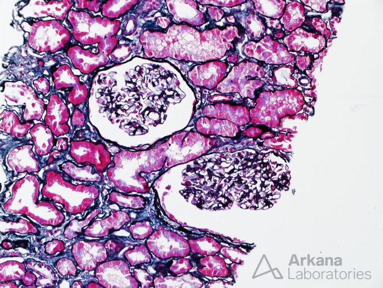 Light Chain Deposition Disease Teaching Points Arkana Laboratories