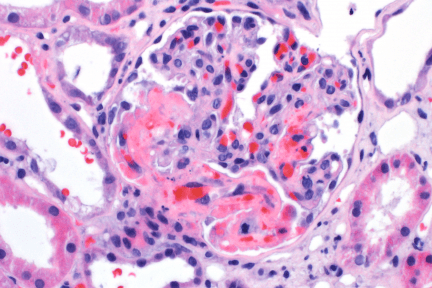 Thrombotic Microangiopathy, renal biopsy, arkana laboratories, glomerulus