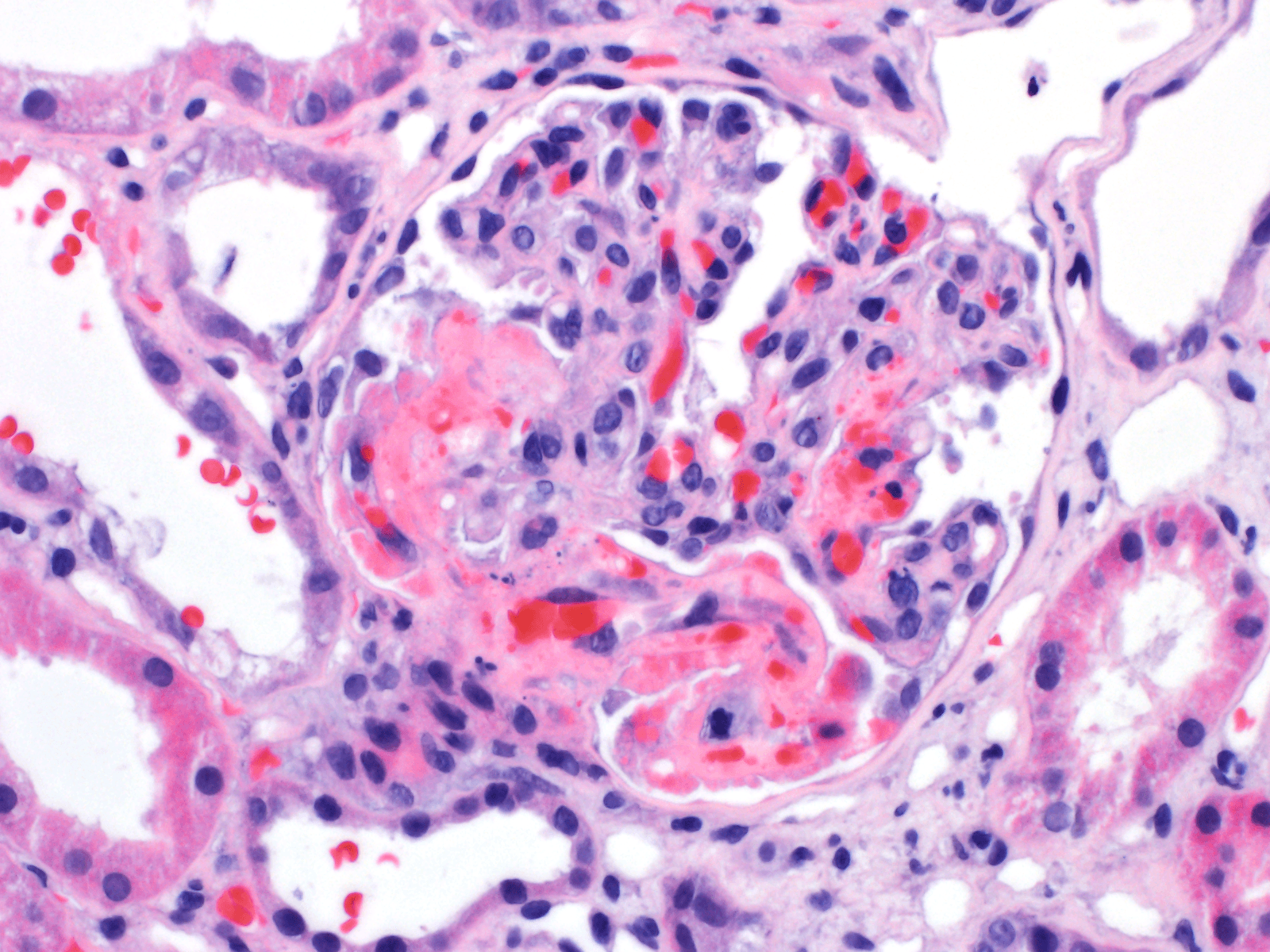 Thrombotic Microangiopathy, renal biopsy, arkana laboratories, glomerulus