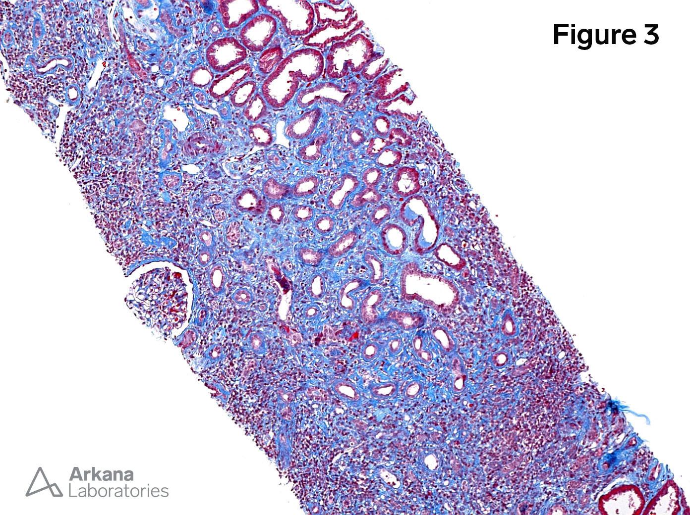 Chronic Active Tubulointerstitial Nephritis