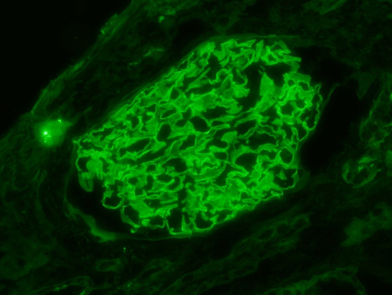 linear glomerular basement membrane staining for IgG, kappa, and lambda