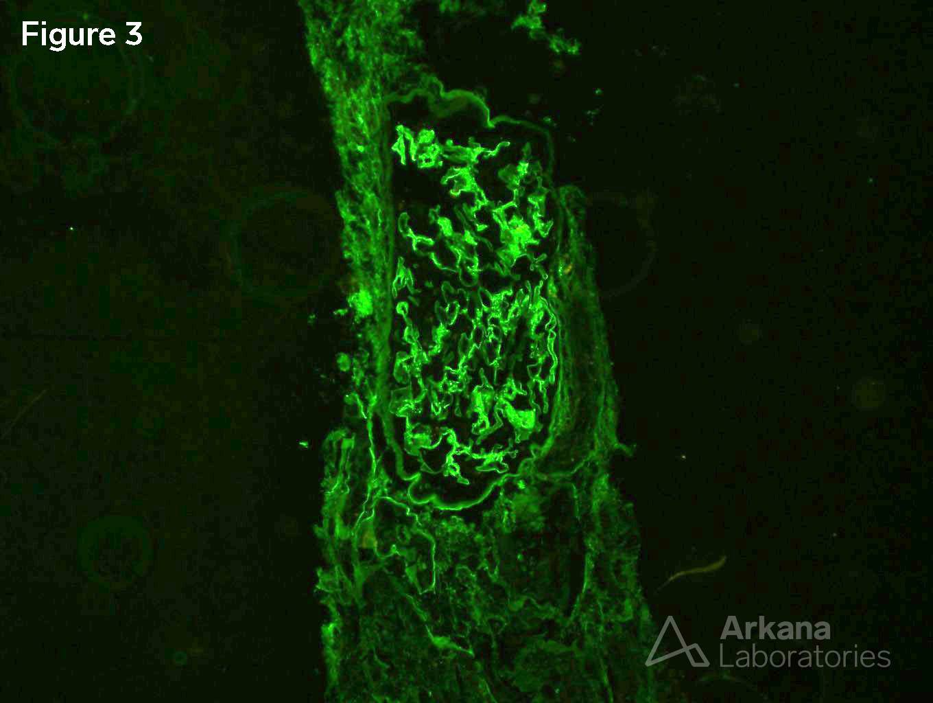 Acute Tubular Injury with Legionella