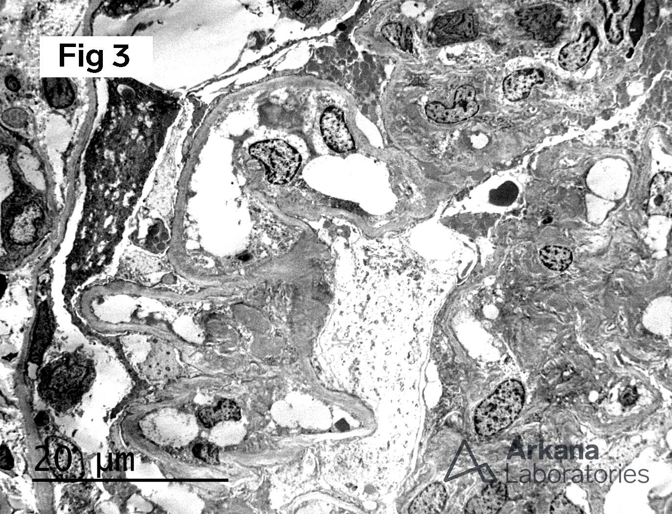 Fibrillary Glomerulopathy, Mesangial and loop fibrillary deposits