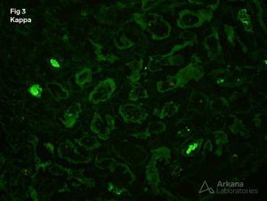 Light Chain Deposition Disease on Kappa IF stain