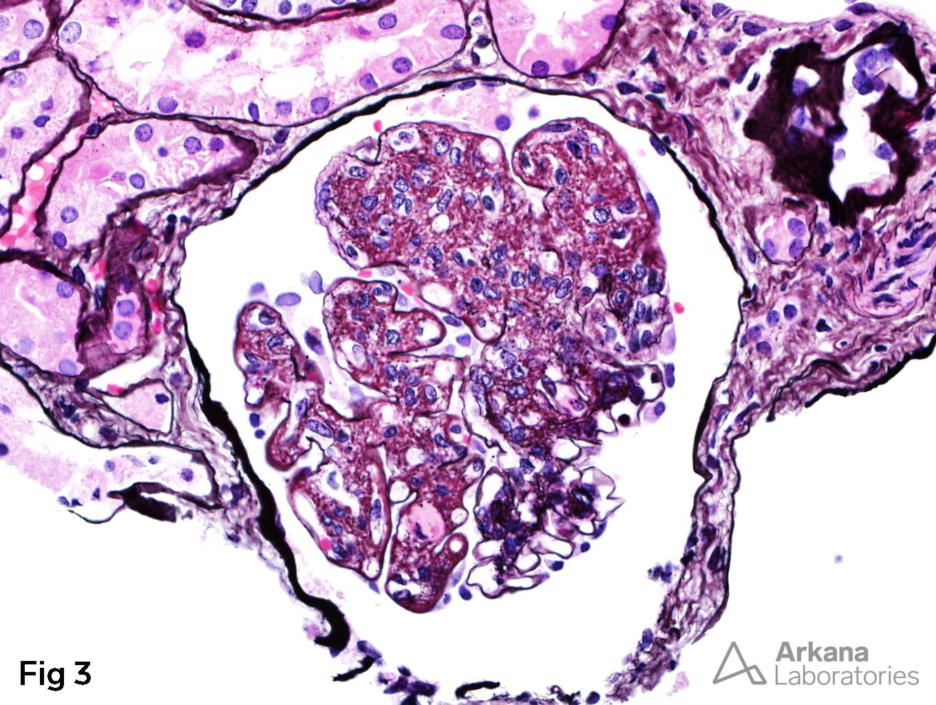 Endocapillary proliferation in more than three-quarters of the glomerulus, Focal Lupus Nephritis