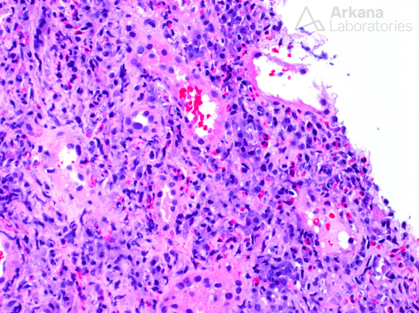 IgG4-related disease