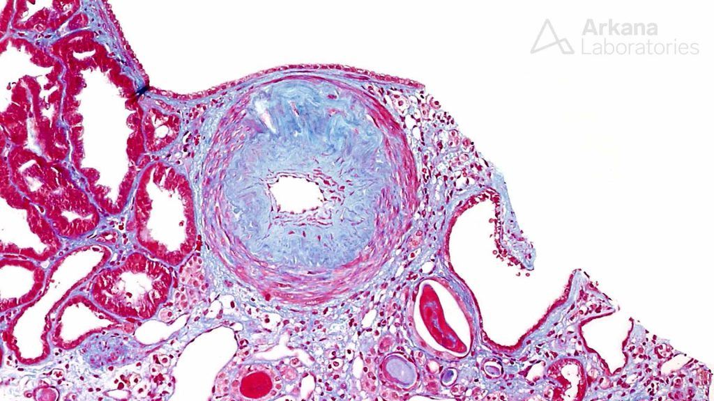 kidney stain, renal biopsy, diagnosis, arkana