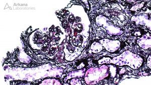 Glomerulus in renal biopsy