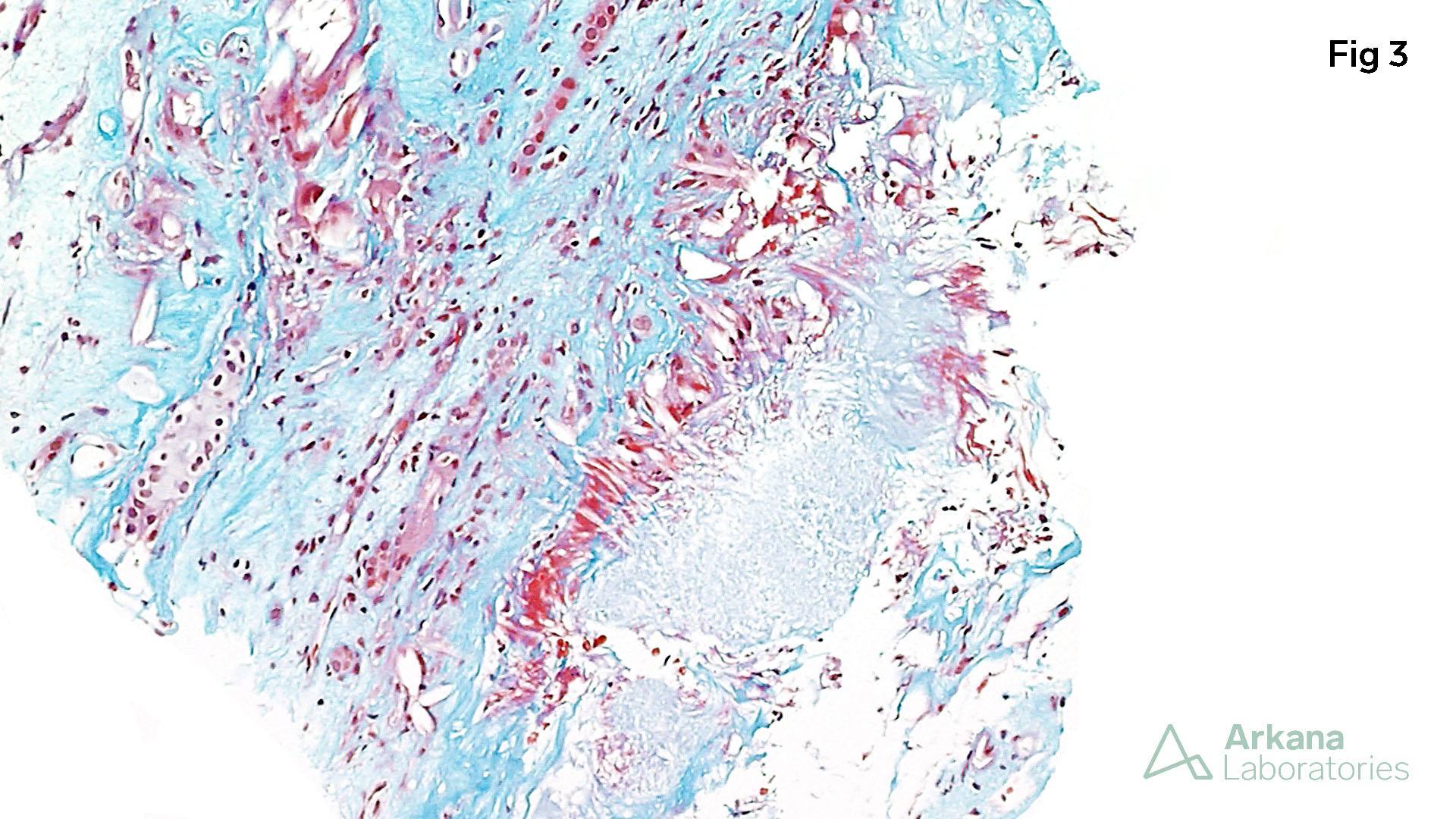 Uric Acid Nephropathy