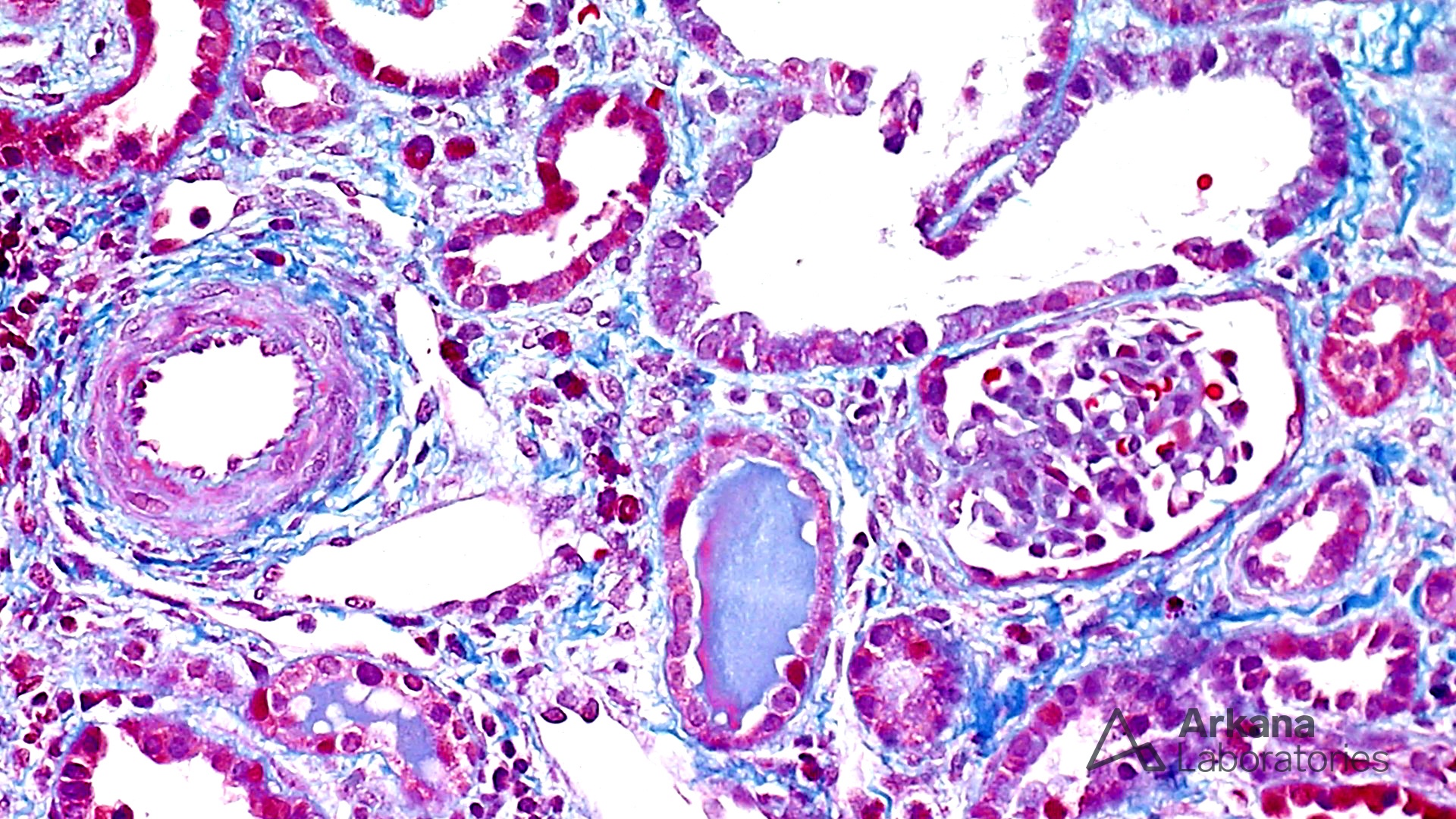 Trichrome stain showing Congenital Nephrotic Syndrome of the Finnish type (CNSF)