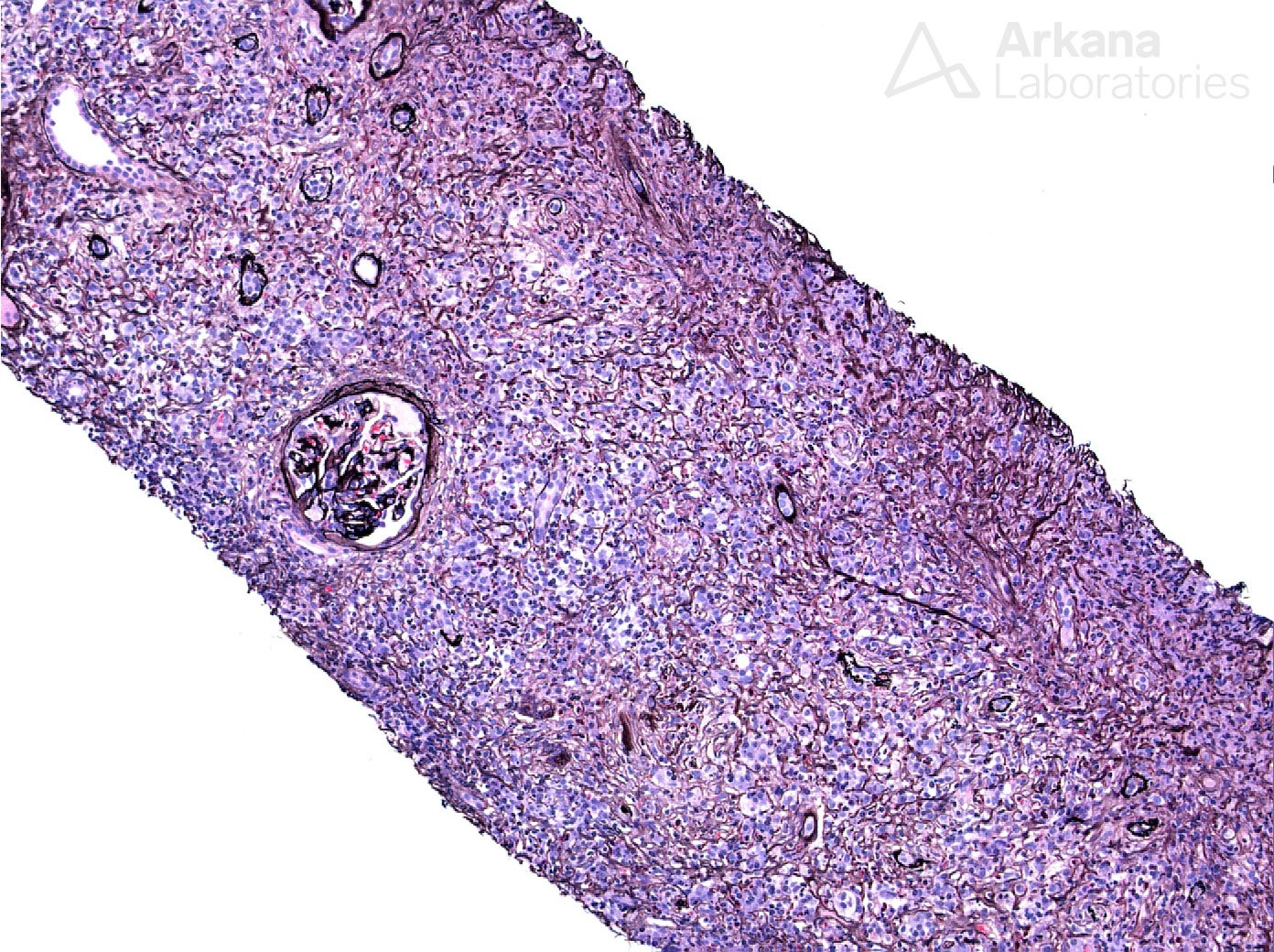 Membranous glomerulopathy