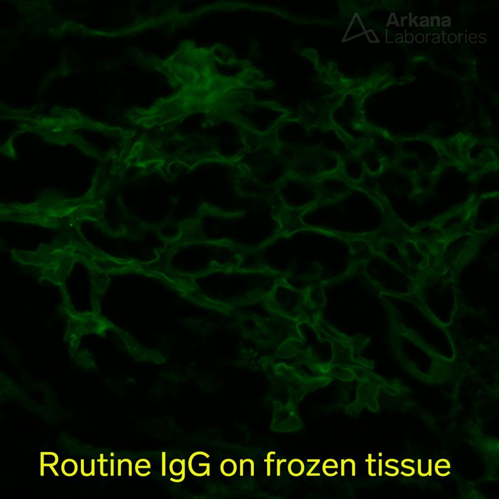 Membranous-Like Glomerulopathy with Masked IgG-Kappa Deposits, IgG stain on frozen renal tissue
