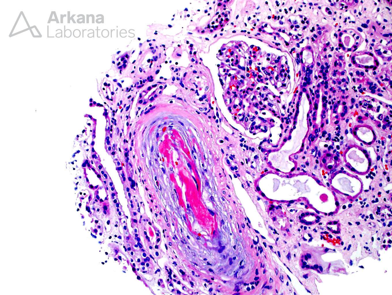 Thrombotic Microangiopathy