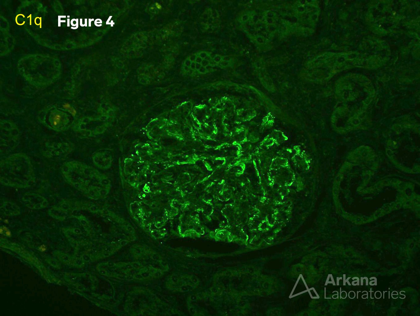 Proliferative Glomerulonephritis with Monoclonal IgG Deposits (PGMID)