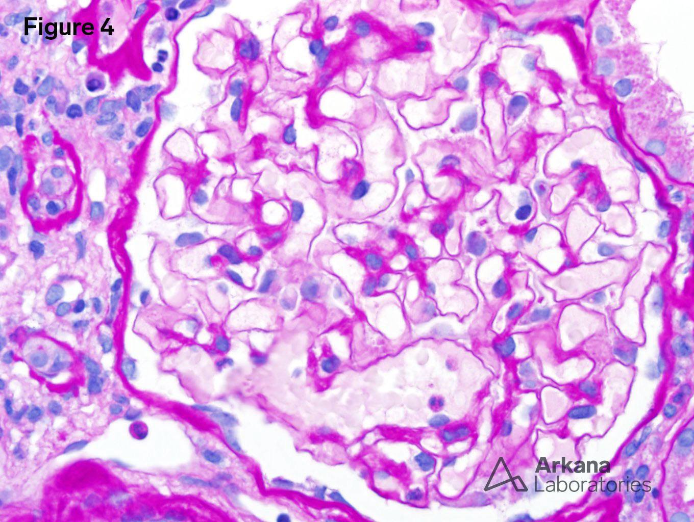 Chronic Active Tubulointerstitial Nephritis