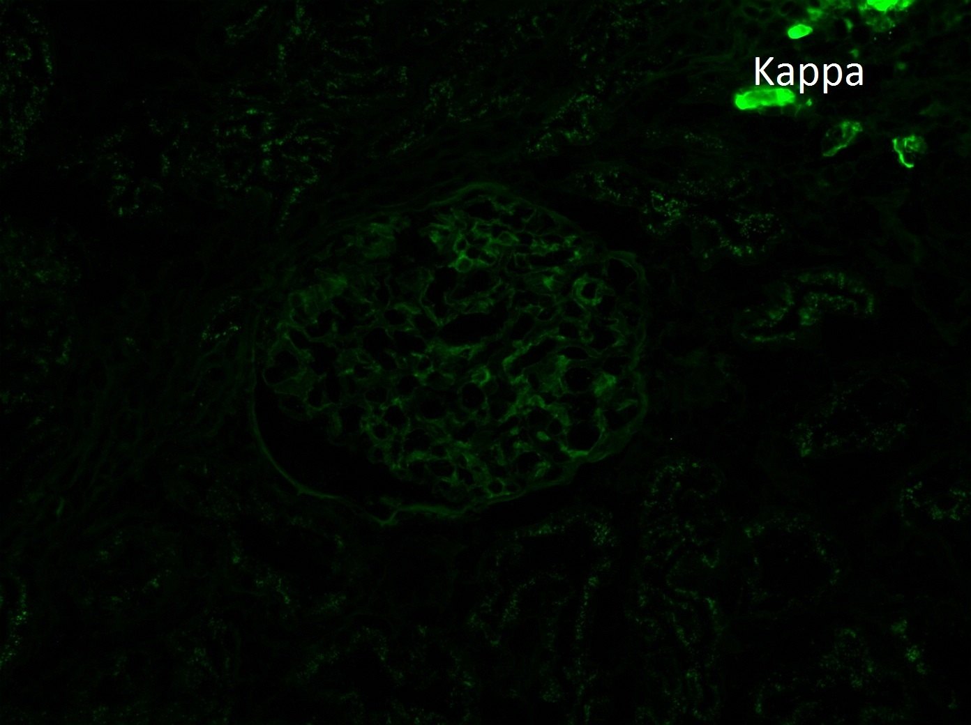 Membranous-like Glomerulopathy with Masked IgG Kappa Deposits