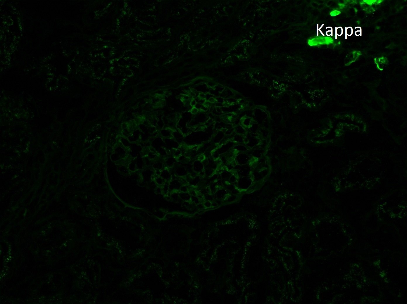 Membranous-like Glomerulopathy with Masked IgG Kappa Deposits