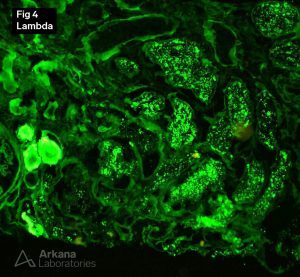 Lambda IF stain showing Light Chain Deposition Disease and Light Chain Proximal Tubulopathy