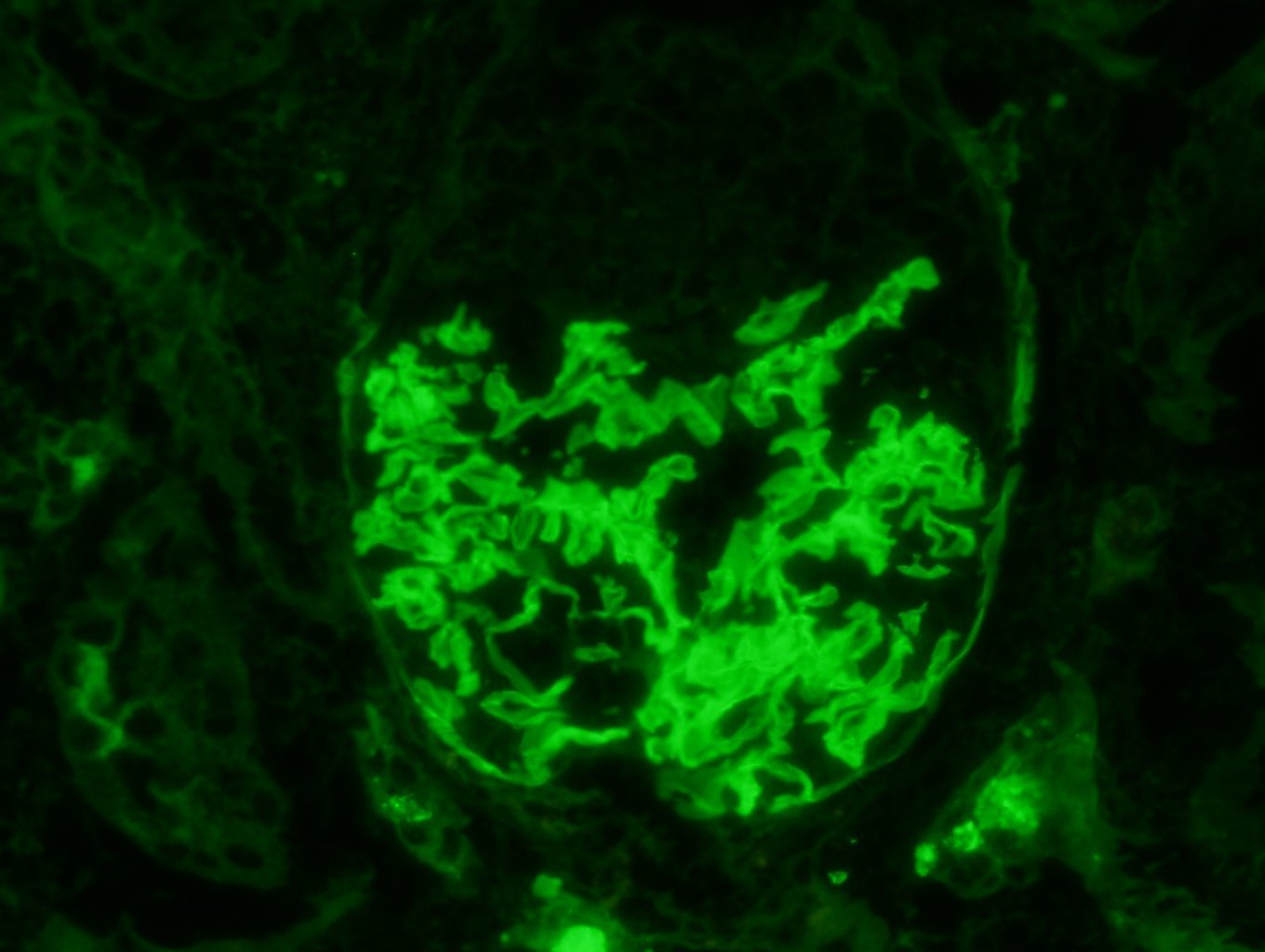 Anti-Glomerular Basement Membrane Disease