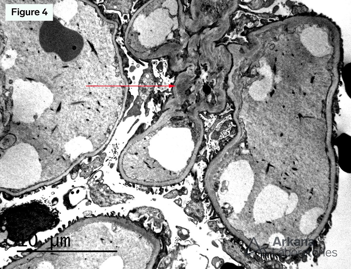 Acute Tubular Injury with Legionella