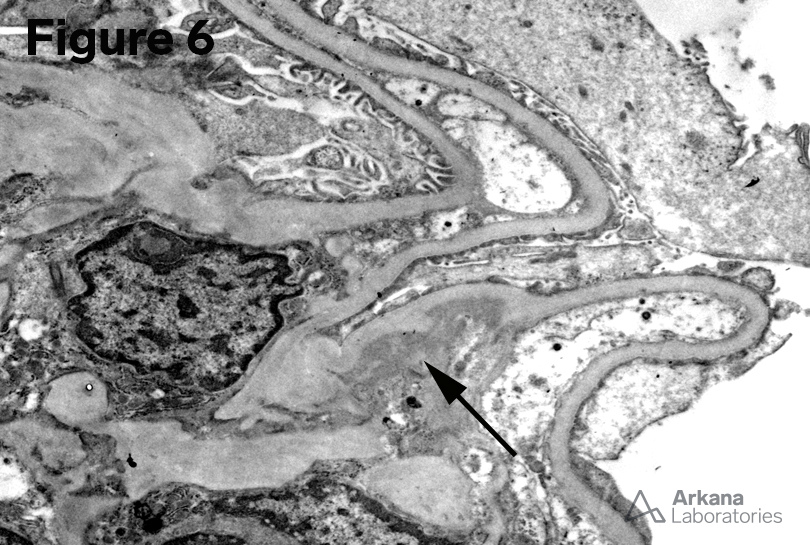 electron microscopy image of Proliferative Glomerulonephritis