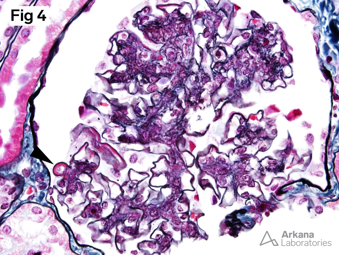 Wire loop (arrowhead) in a glomerulus with only mesangial hypercellularity, Focal Lupus Nephritis