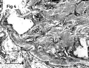 Mesangial and loop fibrillary deposits