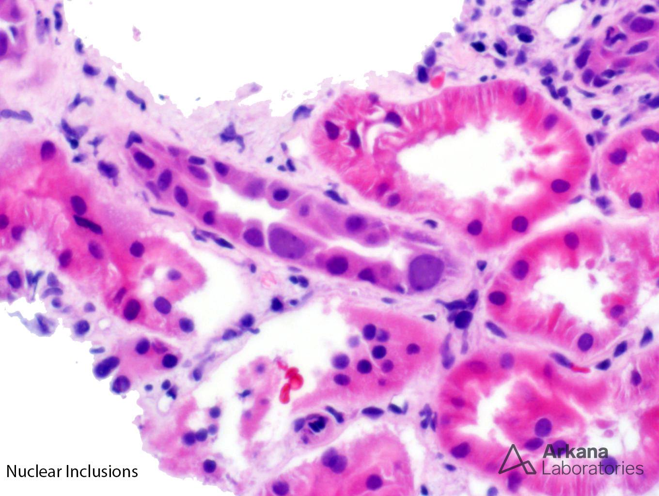 large B-cell lymphoma