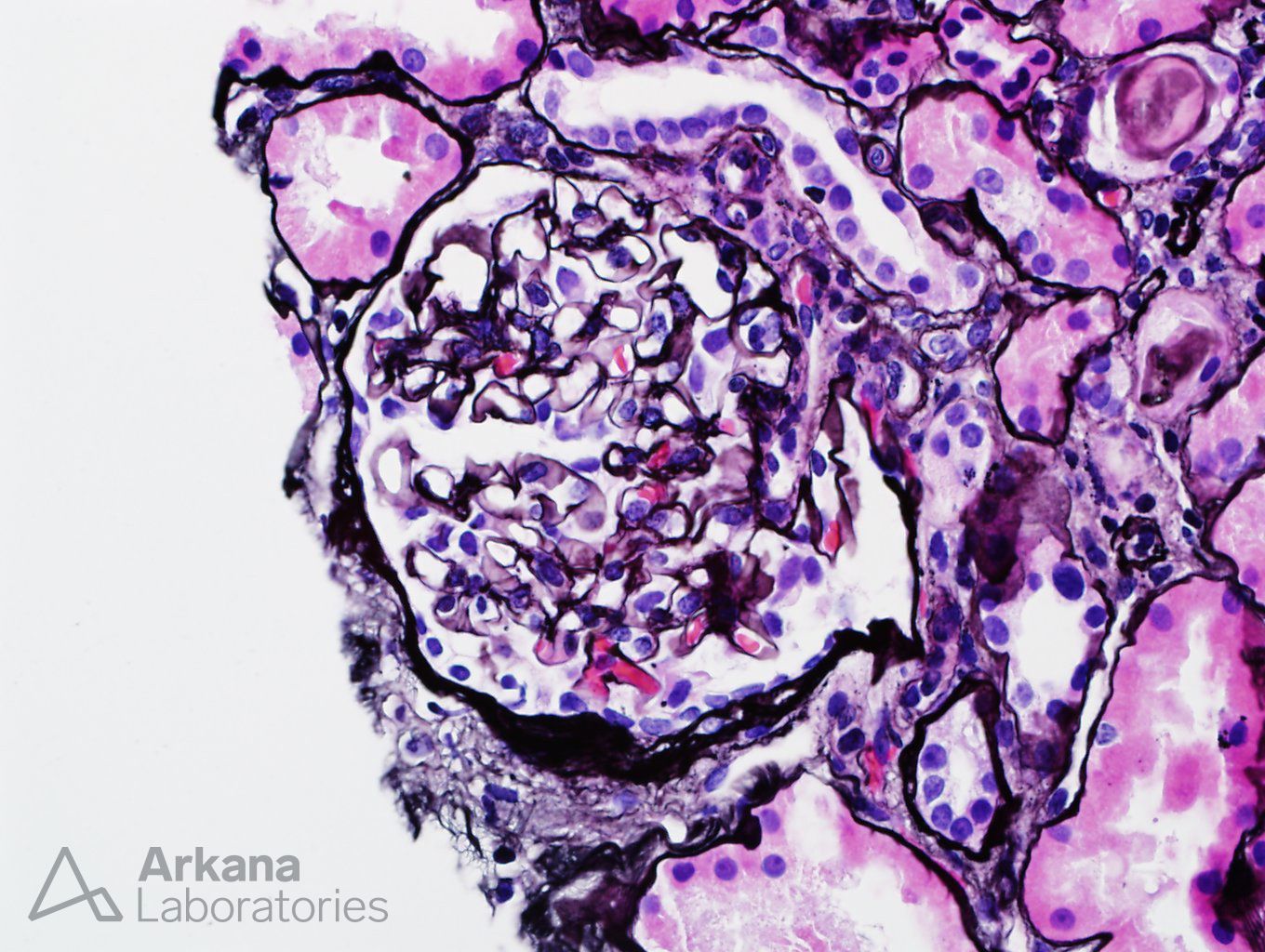 Light Chain Deposition Disease