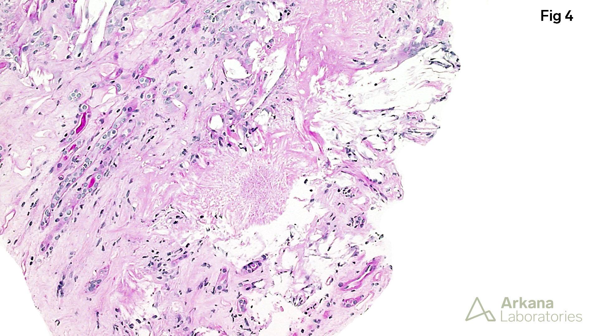 Uric Acid Nephropathy