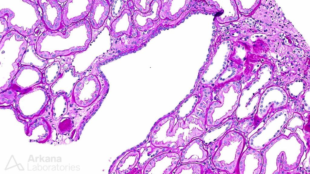 Chronic tubulointerstitial nephropathy, renal pathology, pathology for kidney disease