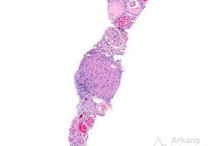 Granulomatous Interstitial Nephritis, renal biopsy, renal cortex