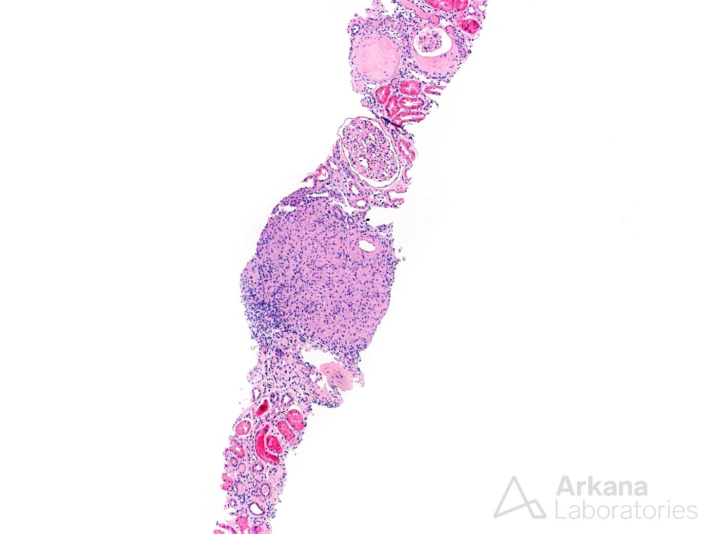 Granulomatous Interstitial Nephritis, renal biopsy, renal cortex