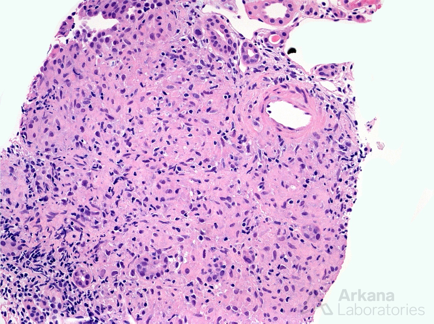 Granulomatous Interstitial Nephritis