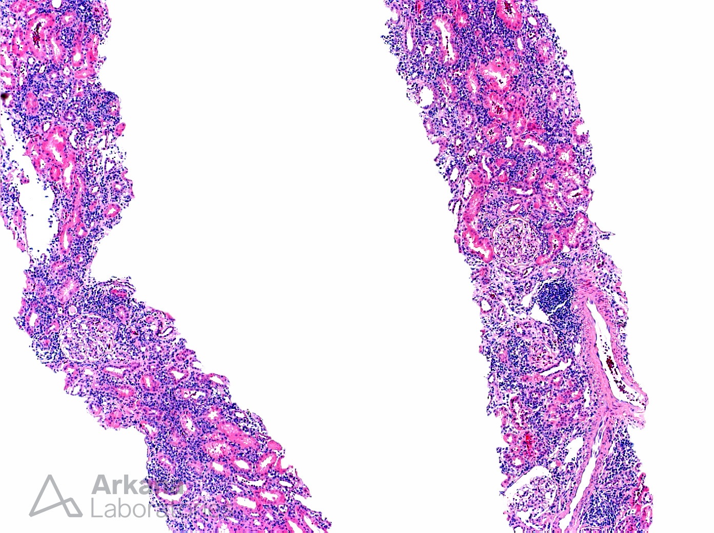 Sjogrens Syndrome