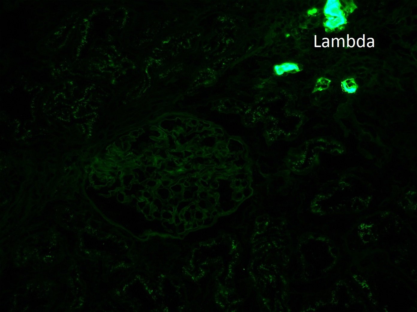 Membranous-like Glomerulopathy with Masked IgG Kappa Deposits