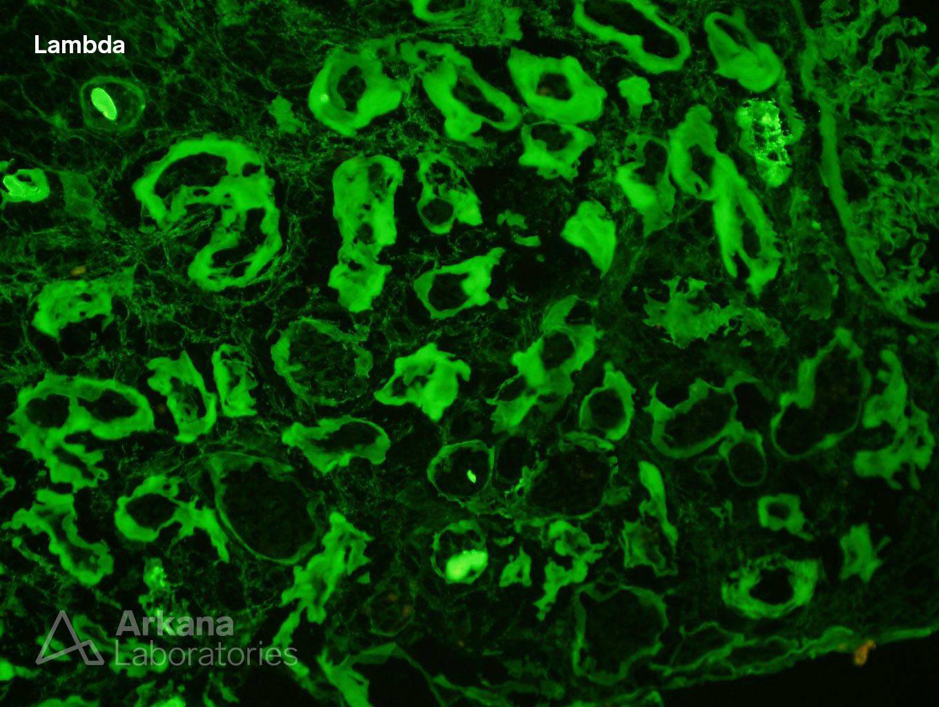 Light Chain Deposition Disease