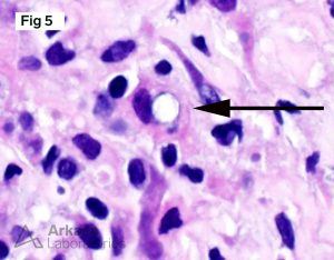 Malakoplakia in a renal biopsy